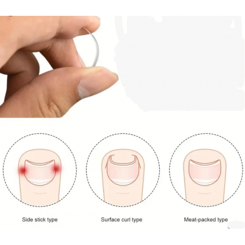 Baş Parmak Tırnak Batmasını Engelleyen Metal Aparat Nrd 603 *